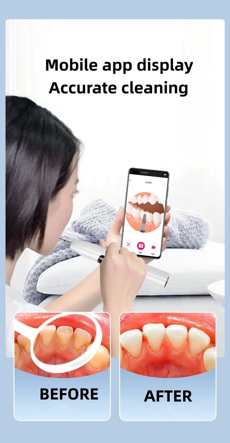 WoWihte Incredible Dental Calculus Remover Teeth 2025 Careful Edition